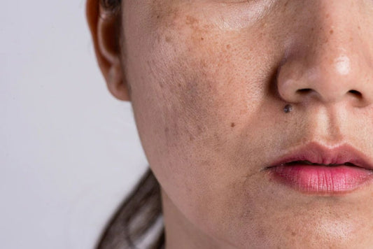 Pigmentation on Face – What is it and How to Get Rid of it?