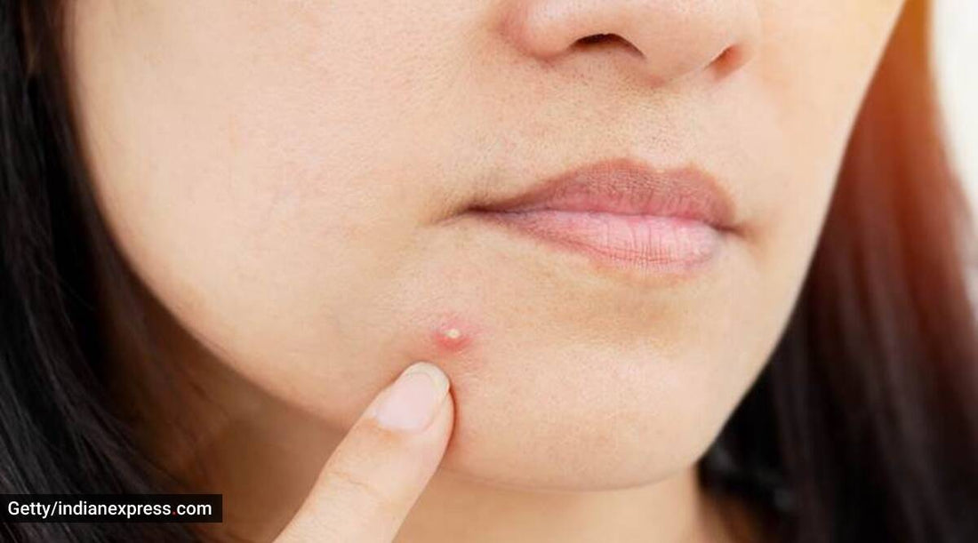 5 Things to Do When You Have a Pimple