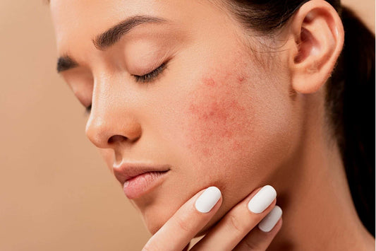 Hormonal Acne? 7 Ways To Balance Sebum (Oil) Production