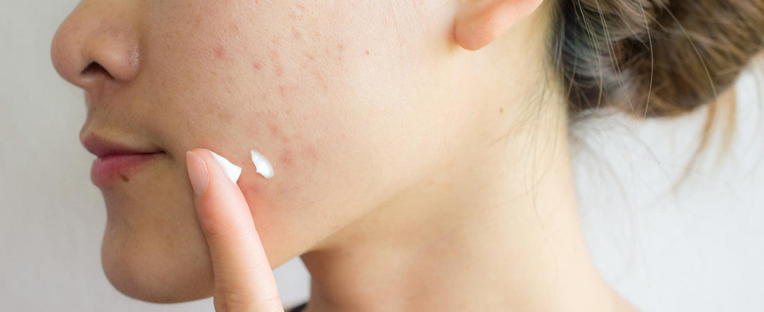 How can I get acne-free skin in a month?