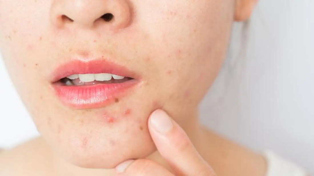 Unknown skin care habits that can worsen your acne