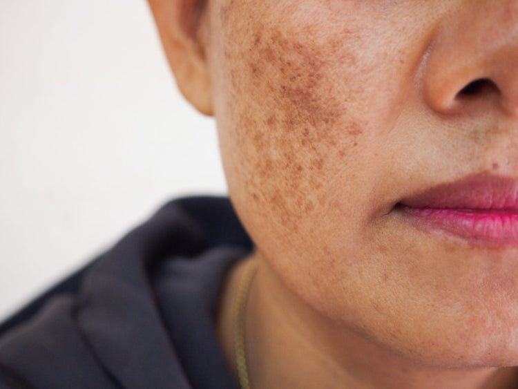 What are Dark Patches on the Skin and How to Treat them? - Unsweetened ...