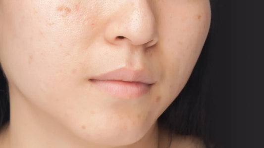 How To Treat Black Spot On The Skin?