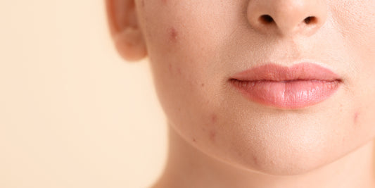 Hormonal acne, the good, the bad and the solution!