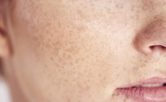 The Link Between Inflammation and Hyperpigmentation