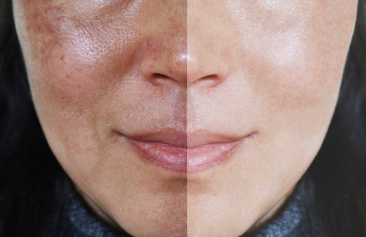 The Best Skin Care Routine for Melasma