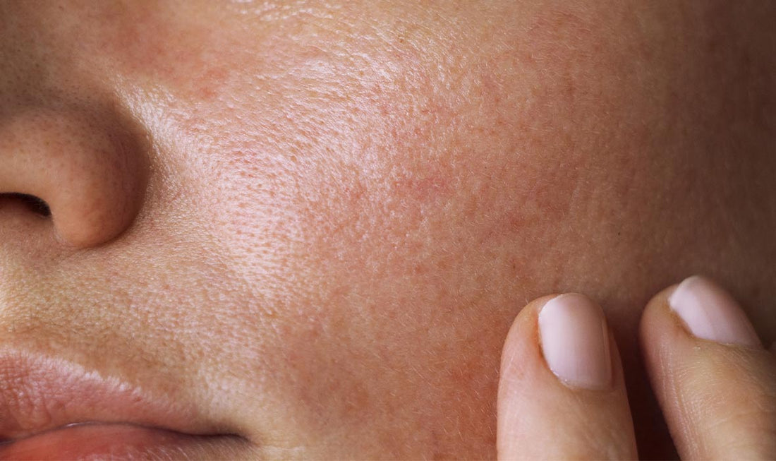 Why does oily skin increase risk of acne?