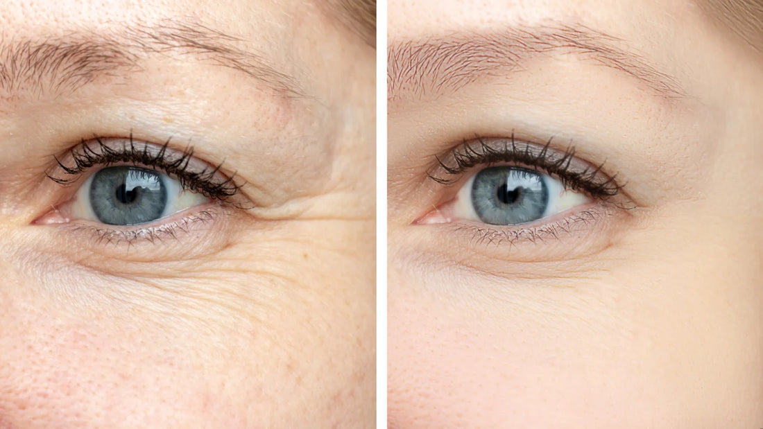 How to Get Rid of Under-Eye Wrinkles?